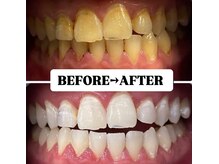 ホワイトニングサロン 豊中/Before&After美白ホワイトニング