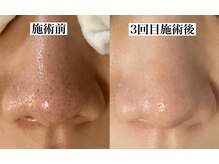 エミナル(eminal)の雰囲気(角栓にお悩みの方はエクストラクションが改善が早くオススメ♪)