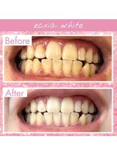 エクシアホワイトフジ(ecxia white fuji)/ホワイトニングビフォーアフター