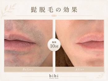 ビビ(bibi)/メンズヒゲ脱毛施術10回