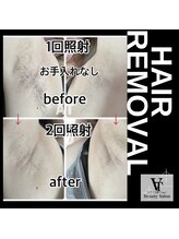 アット(ATTO)/ワキ1回照射