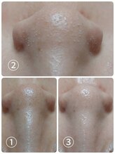 ビアンカーラ(Biancara)/浮き出る【韓国式3D毛穴洗浄】