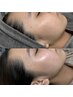 【美肌への近道に】8週間以内　フェイスワックス＋美肌パック付　¥8500