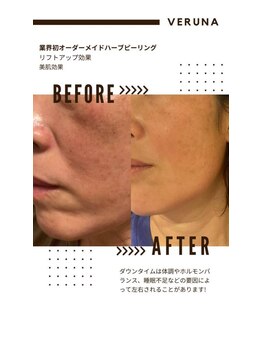 お顔そりローズマリー/ハーブピーリング