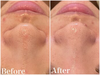 サロンドフェイス(Salon de Faith)/ハーブピーリング