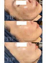 ニコサロン(nico salon)/本気で肌質改善