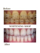 ホワイトニングショップ 岸和田店/お客様のBefore  After