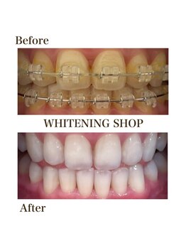 ホワイトニングショップ 岸和田店/お客様のBefore  After