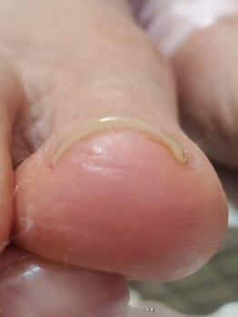 プリマ(prima)の写真/【巻き爪ケア】陥入、肥厚、変形、副爪など☆痛くて靴が履けない等足爪トラブルでお悩みの方必見！