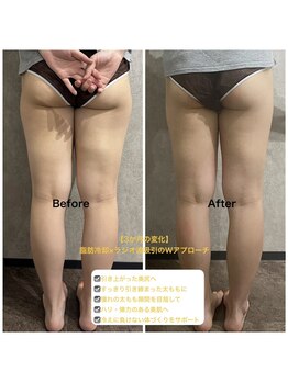 サロン ジプソ(salon Gypso.)の写真/ただ痩せるだけでなく美しく引き締めてサイズダウン。頑固な脂肪に【冷却×温熱】のWボディケア。
