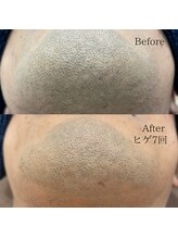 シャレールオム(Chareir Homme)/ヒゲ脱毛7回のビフォーアフター