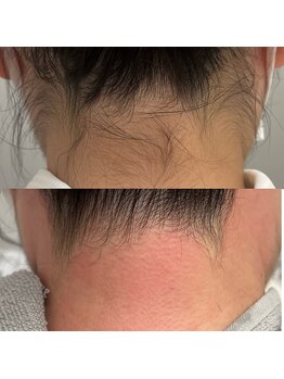 ヌイ(nui)/うなじWAX脱毛