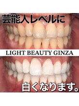 ライトビューティー 銀座店(LightBeauty)/東銀座　ホワイトニング症例写真