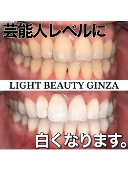 ライトビューティー 銀座店(LightBeauty)/東銀座　ホワイトニング症例写真