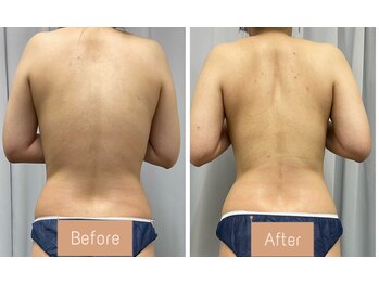 FJ/脂肪撃退コース◎