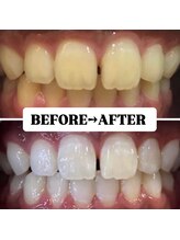 ホワイトニングサロン 豊中/Before&After美白ホワイトニング