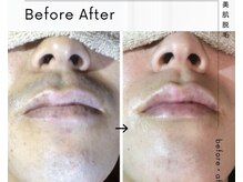 エミナル(EMINAL)/《 before→after 》ヒゲ脱毛