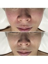 レアリゼ(Realiser)/まずは鎮静！