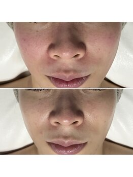 レアリゼ(Realiser)/まずは鎮静!