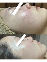 フィール(feel)/ビフォー　アフター　3回施術