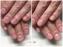 深爪改善実績５万件のリプロ式深爪矯正を道内唯一の導入サロン