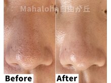 マハロハ 自由が丘(Mahaloha)/【毛穴つまり・黒ずみ改善施術】