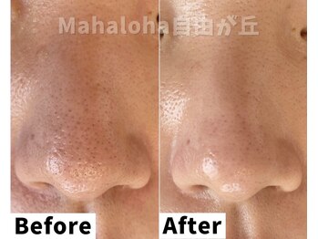 マハロハ 自由が丘(Mahaloha)/【毛穴つまり・黒ずみ改善施術】