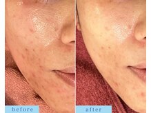 アフロディーテ(APHRODITE)/ビフォーアフター