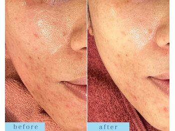 アフロディーテ(APHRODITE)/ビフォーアフター