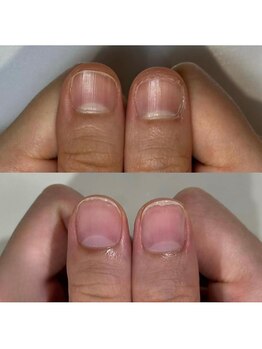 ティアラネイル 宇都宮/深爪矯正