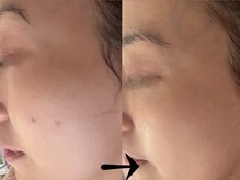 サロン ドロップ 上小田井(Salon drop)/「シミ改善」