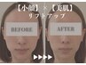 人気急上昇！【速攻小顔×艶肌】インディバフェイシャル60分