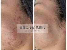 ビューティーブルーム(BeautyBloom)の雰囲気（赤ニキビもしっかり鎮静させてニキビのないお肌作り★）
