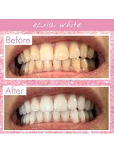 エクシアホワイトフジ(ecxia white fuji)/ホワイトニングビフォーアフター