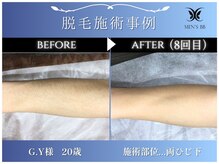 メンズビービー 福井高柳店(MEN'S BB)/ボディ脱毛施術事例