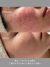 【敏感肌・赤み】 繰り返す赤みをケア◎ゆらがない肌へ
