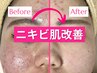 【ニキビケア】繰り返すニキビ・肌荒れ改善｜肌環境を整える