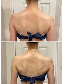 ルナグランデ(Luna grande.)/肩周りのもっこりが解消!