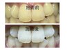 輝く白い歯を目指す　歯のホワイトニング5500円→3800円