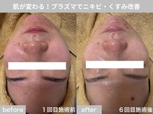 サロン ビュー(salon view)/30代女性〈ニキビ悩み〉　