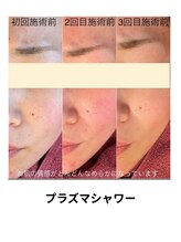 ビービー(BB)/毛穴洗浄＋プラズマシャワー