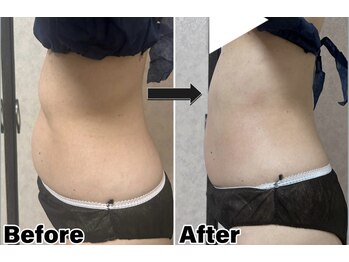 カピリナ(Kapilina)/ WINBACK90 3回【40代後半女性】