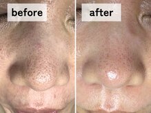 エアル(earu.)/BA|毛穴ケア|ピーリング|高円寺