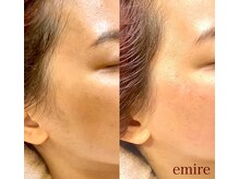 エミレ(emire)/フェイスライン/ワックス脱毛