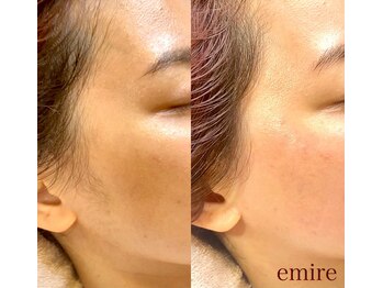 エミレ(emire)/フェイスライン/ワックス脱毛