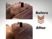 メディカルエステサロン ローズ 金沢本店(ROSE)/レモンボトルフェイシャル