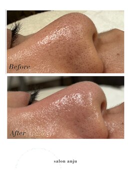 サロン アンジュ(salon.anju)の写真/毛穴洗浄＆ハーブピーリングで黒ずみ・肌荒れ改善へ導く！透明感あふれる肌を実感◎