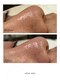 サロン アンジュ(salon.anju)の写真/毛穴洗浄＆ハーブピーリングで黒ずみ・肌荒れ改善へ導く！透明感あふれる肌を実感◎