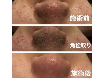 エマ(Emma)の写真/都城希少の海藻パックで徹底大掃除！黒ずみ・開きを優しく浮かせて、思わず触りたくなるつるつる小鼻へ