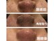エマ(Emma)の写真/都城希少の海藻パックで徹底大掃除！黒ずみ・開きを優しく浮かせて、思わず触りたくなるつるつる小鼻へ